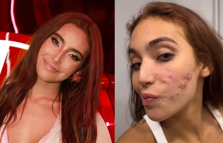 Vanessa Lopes reclama de espinhas no rosto